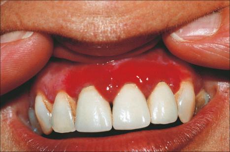 Fig. 12.44, Vulvovaginal-gingival syndrome: note the intense erythema with erosion of the gum.