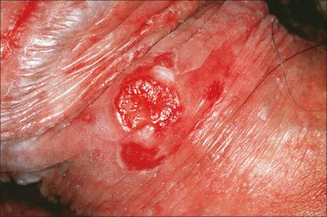 Fig. 12.45, Lichen planus: chronic penile lesion complicated by an ulcerated squamous cell carcinoma.