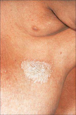 Fig. 12.50, Lichen sclerosus: irregular white plaque. It should be noted that extragenital lesions sometimes occur in the absence of genital lesions.