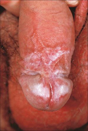 Fig. 12.52, Lichen sclerosus: in males, lesions of the foreskin and glans may be complicated by urethral stricture (so-called balanitis xerotica obliterans).