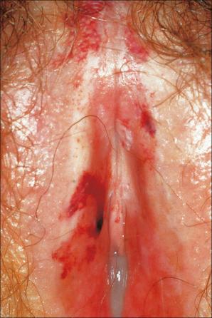 Fig. 12.54, Lichen sclerosus: symmetrical white lesions with gross atrophy and hemorrhage.