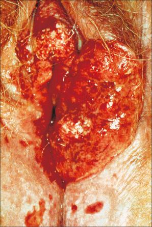 Fig. 12.57, Lichen sclerosus: an ulcerated squamous cell carcinoma has destroyed much of the left side of the vulva. Note the background of ulcerated lichen sclerosus.