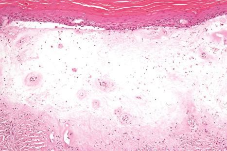 Fig. 12.59, Lichen sclerosus: this example shows the characteristic features of lichen sclerosus. Note the hyperkeratosis, epidermal atrophy, and a broad band of dermal hyalinization. Telangiectatic vessels are prominent.