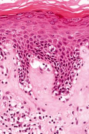 Fig. 12.60, Lichen sclerosus: close-up view of basal cell hydropic degeneration.