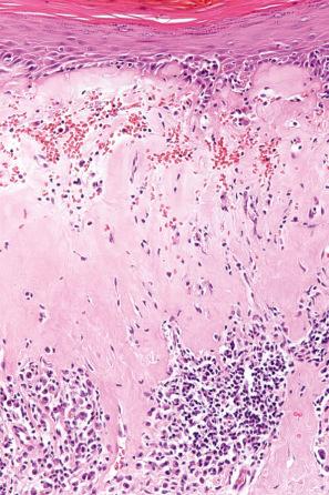 Fig. 12.61, Lichen sclerosus: in this view, the lymphohistiocytic infiltrate is present deep to the zone of hyalinization. There is telangiectasia with hemorrhage.