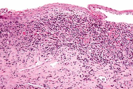 Fig. 12.64, Zoon balanitis: note the epidermal thinning, spongiosis, and a dense superficial inflammatory cell infiltrate.