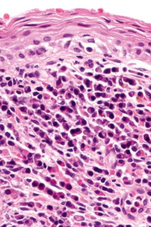 Fig. 12.65, Zoon balanitis: there is ‘lozenge-shaped’ spongiosis and an intense plasma cell infiltrate.