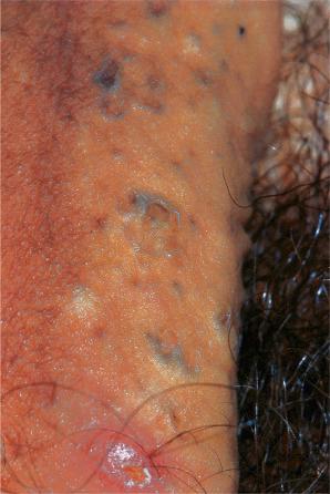 Fig. 12.67, Penile acne: comedones, cysts, and healing inflamed lesions are present on the proximal shaft of the penis.