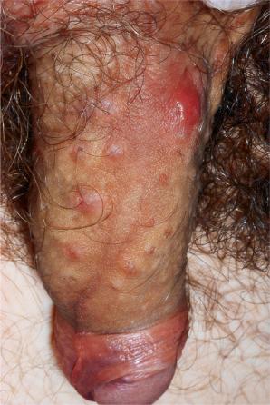 Fig. 12.68, Penile acne: comedones, papules, and nodules are evident.