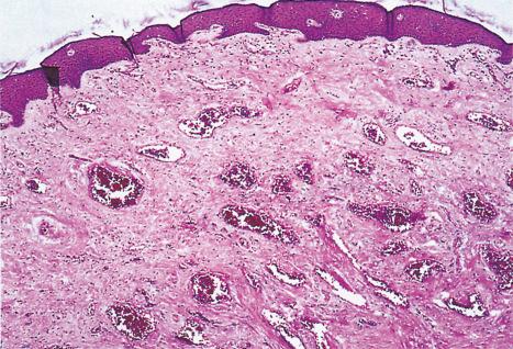 Fig. 12.7, Normal histology of the penis. Glans penis. The three layers of glans are noted: nonkeratinized stratified mucosa, lamina propria, and corpus spongiosum. H&E.