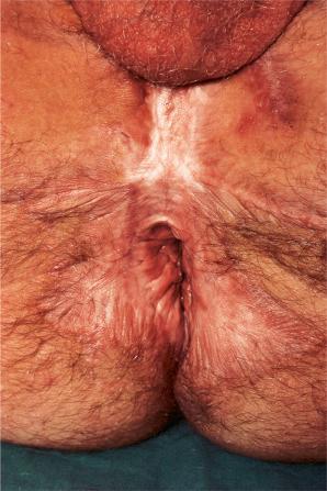 Fig. 12.71, Hidradenitis suppurativa: there is extensive scarring as a result of the disease and also from surgery.