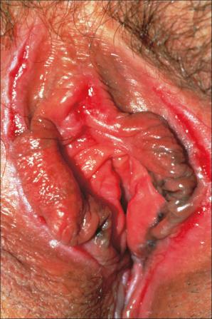 Fig. 12.74, Vulval Crohn disease: note the erythema, edema, and erosions.