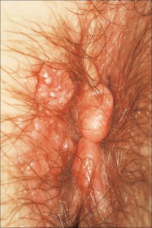 Fig. 12.75, Perianal Crohn disease: multiple skin tags showing massive edema are present.