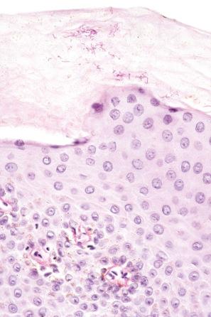 Fig. 12.79, Erythrasma: PAS stain showing elongated bacilli.