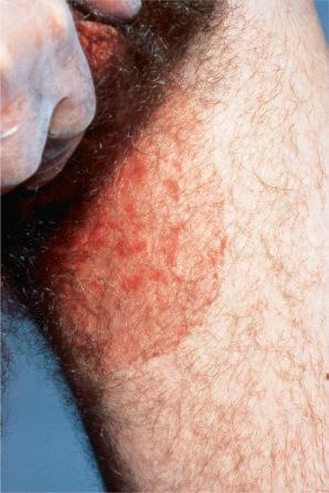 Fig. 12.80, Tinea cruris: there is a large erythematous lesion involving the inner thigh.