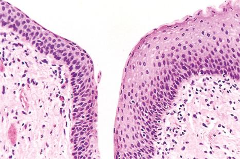 Fig. 12.8, Anal transitional zone (ATZ). Transition from ATZ epithelium (left) to squamous zone (right) . H&E.