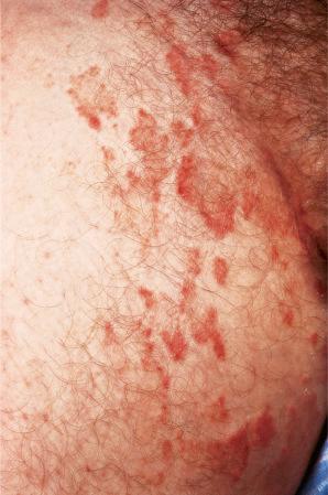 Fig. 12.82, Tinea cruris: close up view.