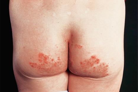 Fig. 12.84, Tinea cruris: note the bilateral involvement of the buttocks.