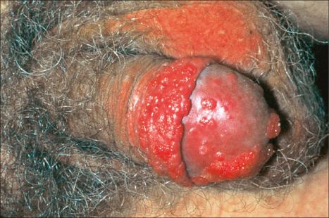 Fig. 12.86, Condyloma acuminatum: multiple erythematous, velvety plaques are present on the glans penis.