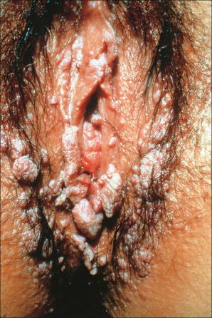 Fig. 12.90, Condyloma acuminatum: there is very extensive disease. The patient is at considerable risk of developing cervical disease.