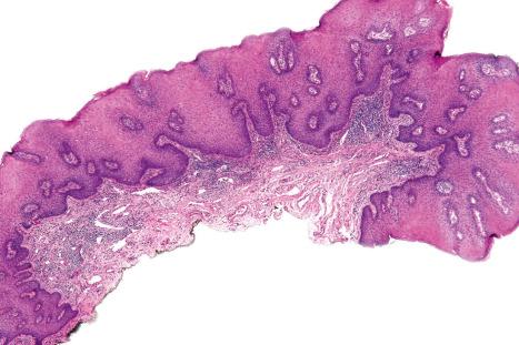 Fig. 12.92, Condyloma acuminatum: there is focal parakeratosis, slight papillomatosis and very marked acanthosis. The lower border is sharply demarcated.