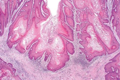 Fig. 12.93, Condyloma acuminatum: this is a much more florid example. Note the gross papillomatosis and very marked acanthosis.