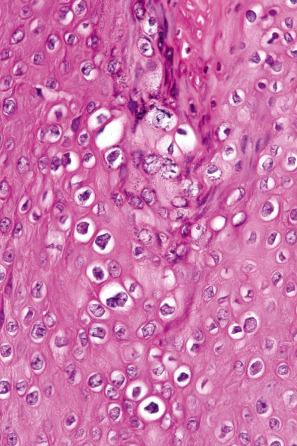 Fig. 12.94, Condyloma acuminatum: there are conspicuous koilocytes with irregular nuclei and vacuolated cytoplasm.