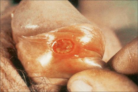 Fig. 12.95, Primary chancre: the chancre is a painless ulcer with an indurated edge. The base is yellow and harbors large numbers of spirochetes.