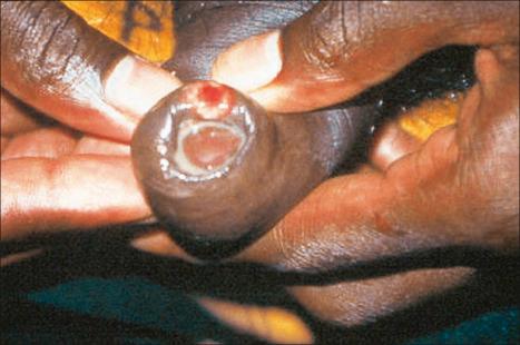 Fig. 12.96, Primary syphilis: painless lymphadenopathy is often present.