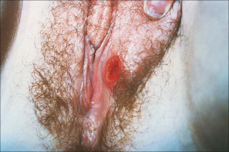 Fig. 12.98, Primary syphilis: a typical chancre is present on the left labium majus.