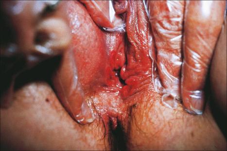 Fig. 12.99, Primary syphilis: typical ‘kissing ulcers’ are present within the vestibule.