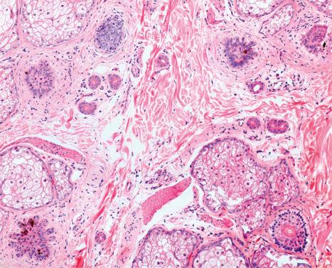 Fig. 22.99, Trichotillomania, pigmented telogen germinal units: in this biopsy there are five follicular structures, and four are telogen germinal units with melanin pigment related to the traumatic extraction of the hairs.