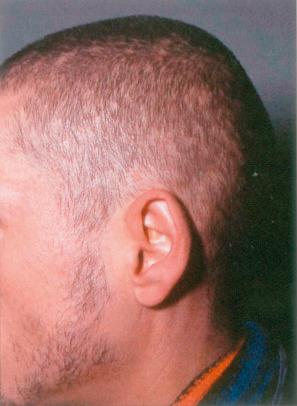 Fig. 22.103, Syphilitic alopecia: typical ‘moth-eaten’ pattern of alopecia.