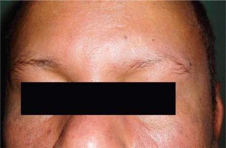 Fig. 22.104, Syphilitic alopecia: loss of eyebrows is not uncommon.