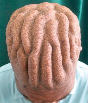 Fig. 22.108, Cutis verticis gyratum. Convoluted folds and furrows formed from thickened skin of the scalp in a cerebriform pattern.