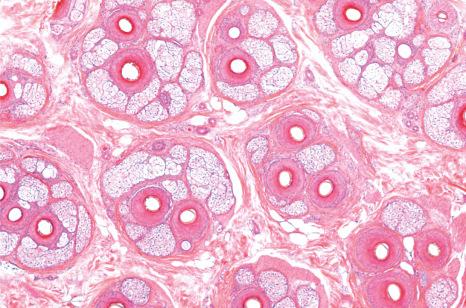 Fig. 22.11, Hair biopsy, horizontal section: the follicular units are clearly delineated by condensation of the adventitial collagen (Masson trichrome stain).