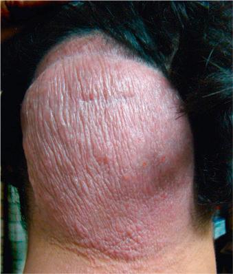 Fig. 22.109, Scarring alopecia secondary to folliculotropic mycosis fungoides. There is total loss of hair in the occipital and posterior parietal regions.