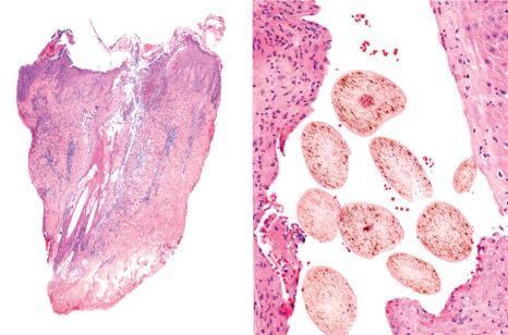 Fig. 22.112, Scarring alopecia, folliculitis decalvans. Vertical and horizontal sections. The destruction of hair follicles and sebaceous glands is associated with peri and interfollicular fibrosis. On the right side, fusion of follicles with numerous hair shafts associated with a single infundibulum (tufted folliculitis).