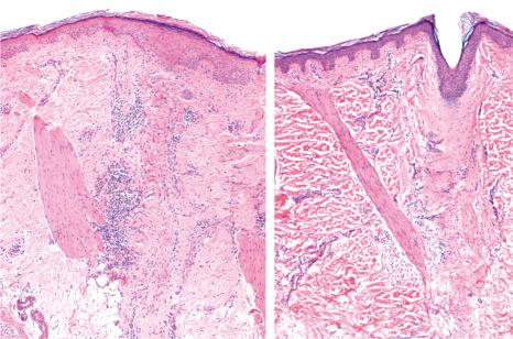 Fig. 22.115, Scarring alopecia, lichen planopilaris: the hair follicles have disappeared and been replaced by two vertical fibrous scars in which an arrector pili muscle is inserted.