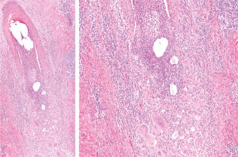 Fig. 22.118, Folliculitis decalvans: the hair follicle has ruptured and the intrafollicular neutrophils spill into the dermis inducing a strong granulomatous inflammatory response.