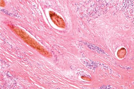 Fig. 22.119, Acne keloidalis nuchae. Multiple free hair shafts in the dermis surrounded by dense scarring.