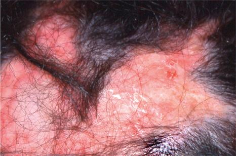 Fig. 22.121, Discoid lupus erythematosus: note the erythema, scaling, follicular plugging and scarring alopecia.