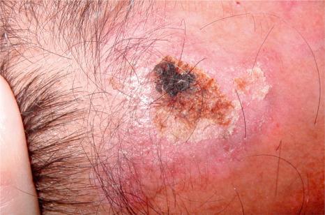 Fig. 22.122, Discoid lupus erythematosus. In this plaque, of alopecia, inflammatory activity is present at the periphery as well as in the center and there is crusting and erythema.