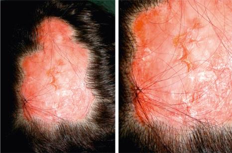 Fig. 22.123, Discoid lupus erythematosus: large erythematous plaque with telangiectasia, scarring, atrophy, and loss of hair, in the interparietal area.