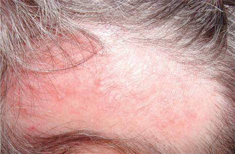 Fig. 22.124, Discoid lupus erythematosus: atrophic plaque with scarring, and loss of hair.