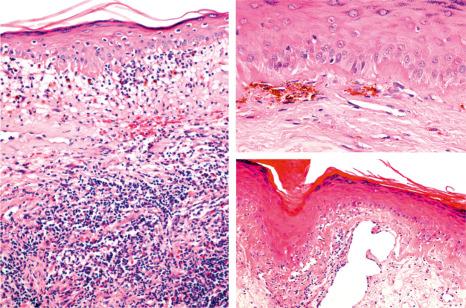 Fig. 22.127, Discoid lupus erythematosus. This image shows the typical histologic features of lupus erythematosus. Note the marked interface change and vacuolar degeneration of basal keratinocytes. In the dermis, there is a mononuclear inflammatory infiltrate with edema. The basement membrane is thickened.