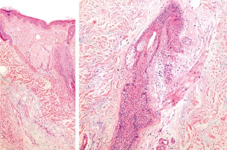 Fig. 22.128, Tumid lupus erythematosus: view of the dermis showing abundant mucin in this case with scalp involvement.