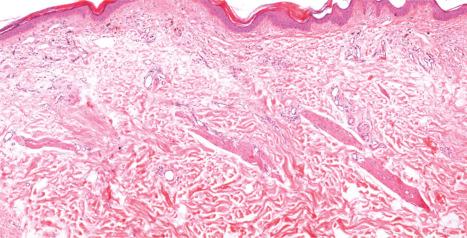 Fig. 22.131, Discoid lupus erythematosus, late stage: the hair follicles have completely disappeared, leaving follicular stellae and arrector pili muscles. In the papillary dermis, there are melanophages, and telangiectasia is evident. The inflammatory cell infiltrate is minimal.