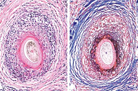 Fig. 22.135, Lichen planopilaris, frontal fibrosing alopecia type: horizontal sections. Left : the destruction of the outer root sheath is evident with interface change, fibrosis and lymphocytic inflammation. Right : with the Mason trichrome staining, the lamellar fibrosis around the mononuclear cell infiltrate is apparent.