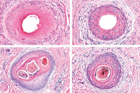 Fig. 22.136, Lichen planopilaris, horizontal sections: photographic composition of the typical changes. ( Top ) Initial changes with apoptosis and loss of internal root sheath. ( Bottom ) Advanced changes with fusion of follicles and thinning of the outer root sheath.